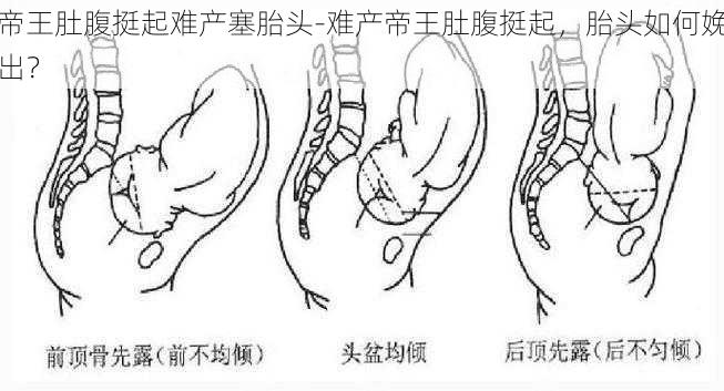 帝王肚腹挺起难产塞胎头-难产帝王肚腹挺起，胎头如何娩出？